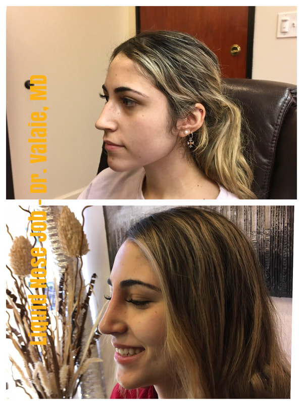 Nose Filler Injection - non-surgical nose job - liquid rhinoplasty by Dr. Valaie, MD - Cosmetic Surgeon Newport Beach, Orange County, CA
