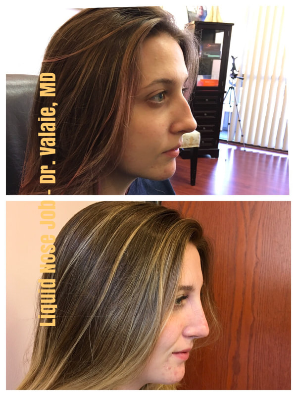 Liquid Nose Job using Restylane dermal fillers by Dr. Valaie, MD Cosmetic Surgeon, Newport Beach, Orange County CA 