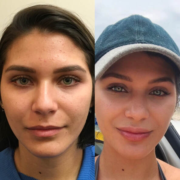 Lip Fillers by Dr. Valaie, MD - Cosmetic Sugeron Newport Beach, Orange County, Calilfornia - Using Juvederm, Restylane, Radiesse, Bellafill, Botox, Dysport, Xeomin