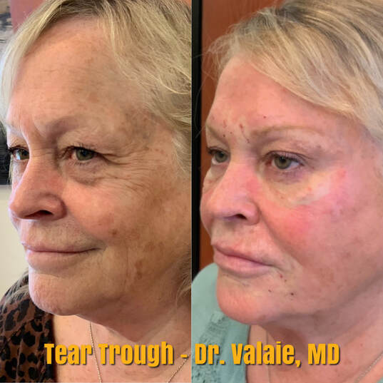 Tear Trough, by Dr. Valaie, MD - Cosmetic Surgeon Newport Beach, Orange County, CA - Using Juvederm, Restylane, Radiesse, Bellafill, Botox, Dysport, Xeomin