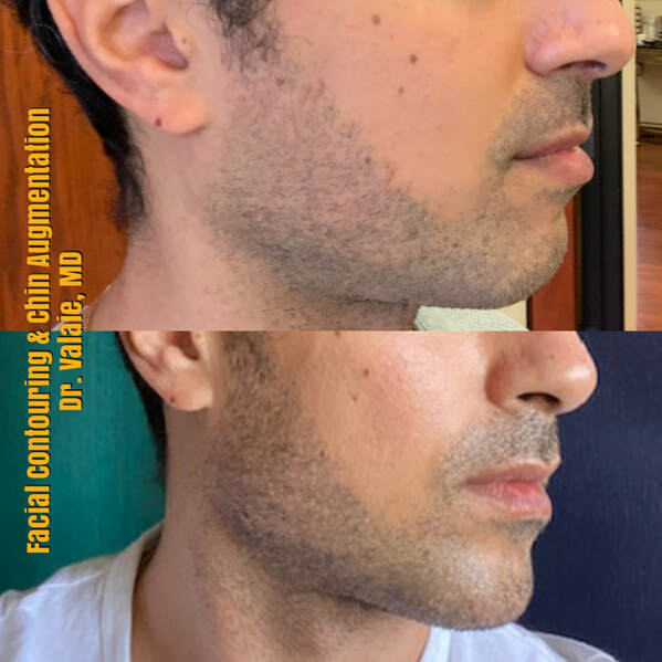 Facial Contouring & Chin Augmentation by Dr. Valaie, MD - Cosmetic Surgeon Newport Beach, Orange County, CA - Using Juvederm, Restylane, Radiesse, Bellafill, Botox, Dysport, Xeomin