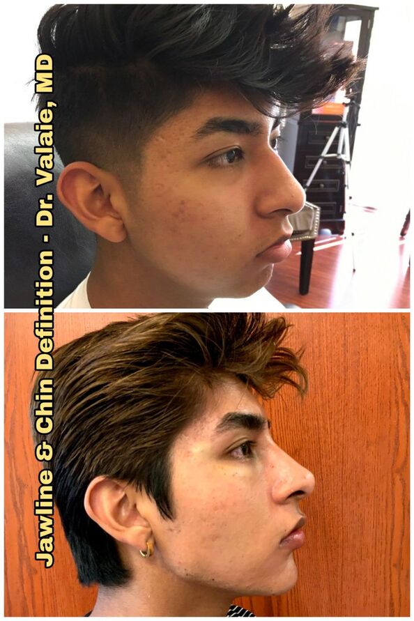 Jawline Contouring by Dr. Valaie, MD - Using Juvederm, Restylane, Radiesse, Bellafill, Botox, Dysport, Xeomin