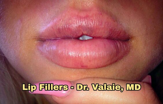 Lip Fillers by Dr. Valaie, MD - Cosmetic Surgeon Newport Beach, Orange County, CA - Using Juvederm, Restylane, Radiesse, Bellafill, Botox, Dysport, Xeomin