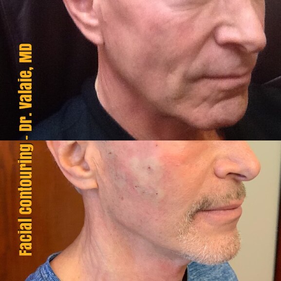 Facial Contouring & Chin Augmentation by Dr. Valaie, MD - Cosmetic Surgeon Newport Beach, Orange County, CA - Using Juvederm, Restylane, Radiesse, Bellafill, Botox, Dysport, Xeomin