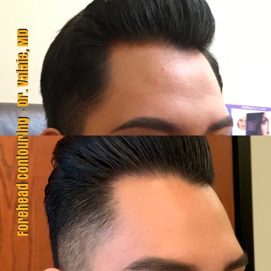 Forehead Contouring by Dr. Valaie, MD - Cosmetic Surgeon Newport Beach, Orange County, CA - Using Juvederm, Restylane, Radiesse, Bellafill, Botox, Dysport, Xeomin