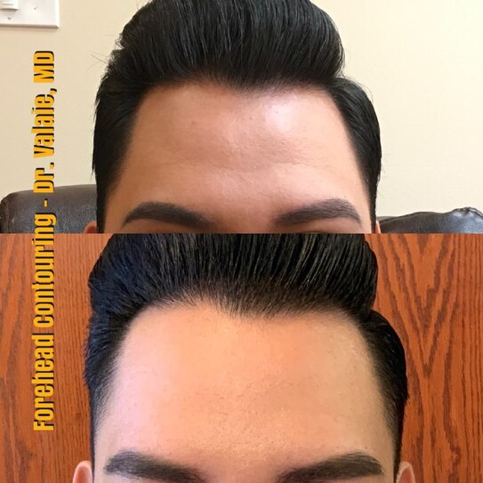 Forehead Contouring by Dr. Valaie, MD - Cosmetic Surgeon Newport Beach, Orange County, CA - Using Juvederm, Restylane, Radiesse, Bellafill, Botox, Dysport, Xeomin