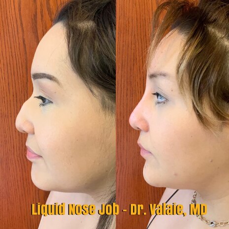 Liquid Nose Job by Dr. Valaie, MD - Cosmetic Surgeon Newport Beach, Orange County, CA - Using Juvederm, Restylane, Radiesse, Bellafill, Botox, Dysport, Xeomin