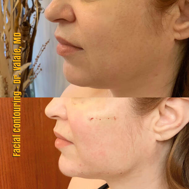 Facial Contouring by Dr. Valaie, MD - Cosmetic   Surgeon Newport Beach, Orange County, CA
