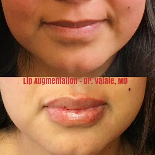 Lip Augmentation  by Dr. Valaie, MD - Cosmetic Surgeon Newport Beach, Orange County, CA