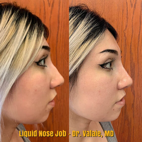 Nose Filler Injection by Dr. Valaie, MD Newport Beach, Orange County - Using Juvederm, Restylane, Radiesse, Bellafill, Botox, Dysport, Xeomin