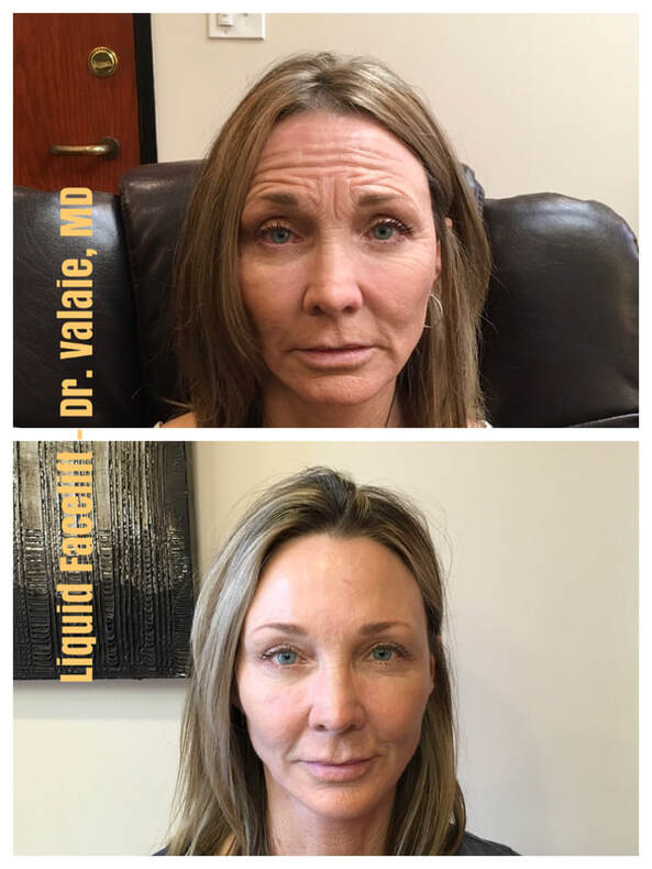 Liquid Facelift using Juvederm, Botox, Radiesse and Restylane dermal fillers by Dr. Valaie, MD Cosmetic Surgeon, Newport Beach, Orange County CA - Using Juvederm, Restylane, Radiesse, Bellafill, Botox, Dysport, Xeomin