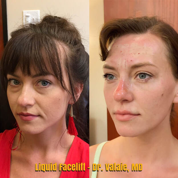 Liquid Facelift by Dr. Valaie, MD - Cosmetic Surgeon Newport Beach,  Orange County, CA