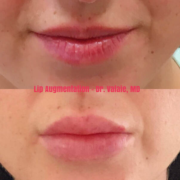 Lip Fillers - Dr. Valaie, MD - Cosmetic Surgeon - Newport Beach, CA - Using Juvederm, Restylane, Radiesse, Bellafill, Botox, Dysport, Xeomin