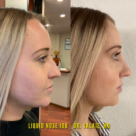 Liquid Nose Job by Dr. Valaie, MD - Cosmetic Surgeon Newport Beach,  Orange County, CA