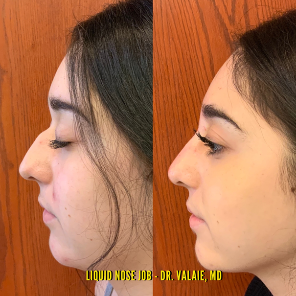 Liquid Nose Job by Dr. Valaie, MD - Cosmetic Surgeon Newport Beach,  Orange County, CA