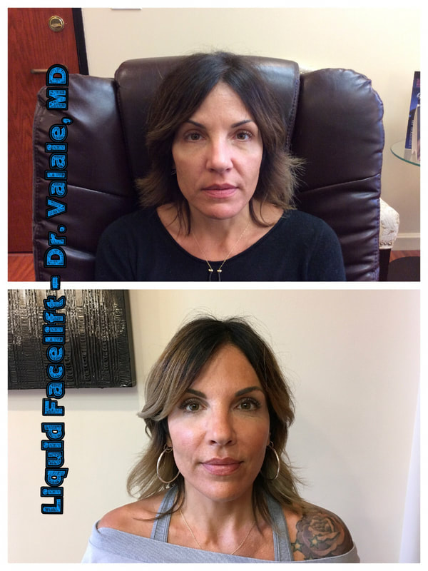 Liquid Face Lift Before & After - Dr. Valaie