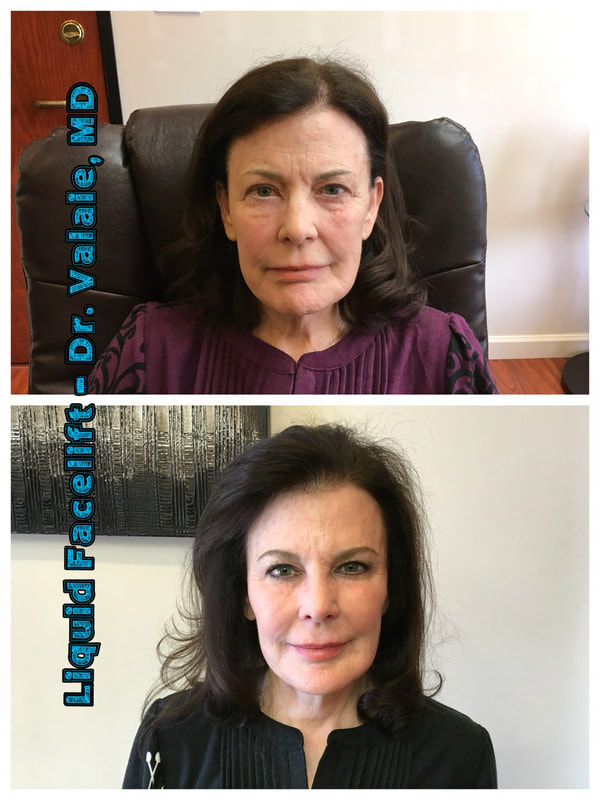 Bags Under Eyes Treatment by Dr. Valaie, MD - Newport Beach, Orange County
