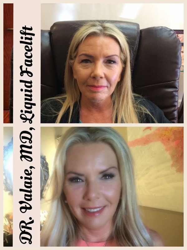 Liquid Facelift by Dr. Valaie, cosmetic surgeon at Newport Beach, Orange County