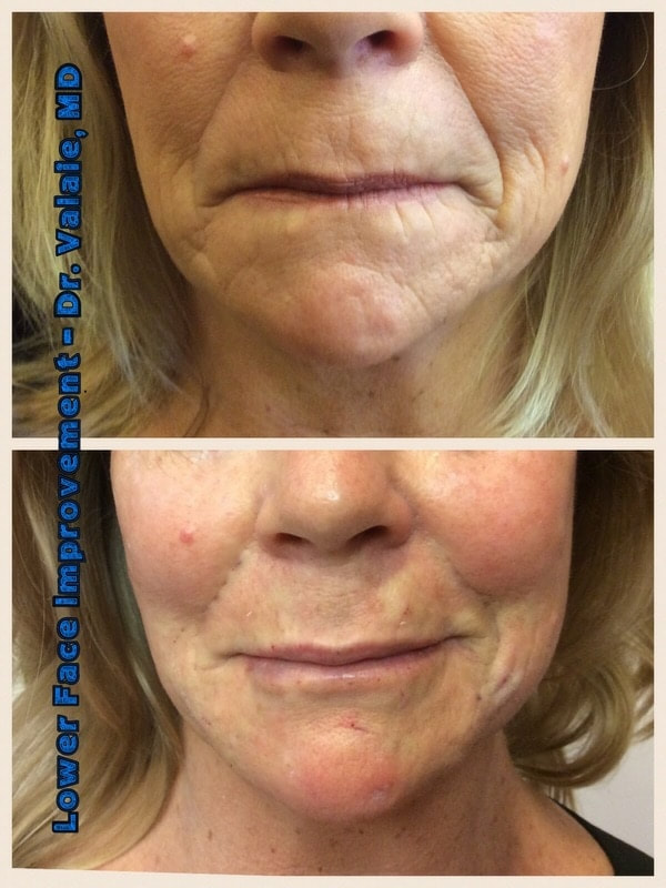 Lip Augmentation by Dr. Valaie, MD - Cosmetic Surgeon at Newport Beach, Orange County