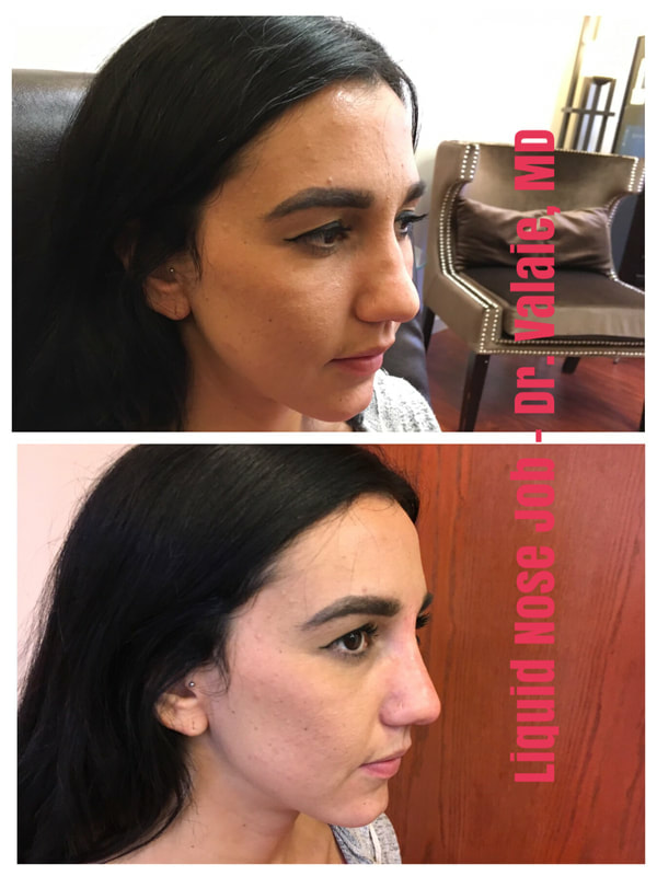 Liquid Nose Job by Dr. Valaie, MD - Cosmetic Surgeon at Newport Beach, Orange County