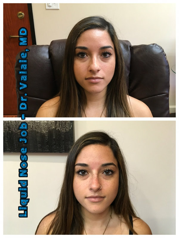 Liquid Nose Job by Dr. Valaie, MD - Cosmetic Surgeon at Newport Beach, Orange County