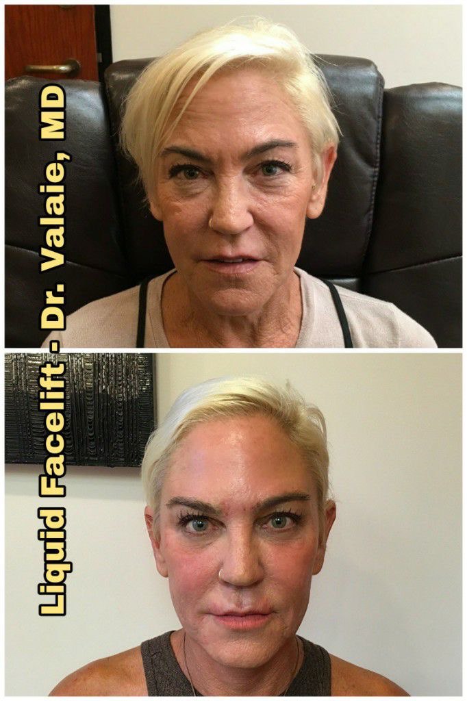 Liquid Face Lift Before & After - Dr. Valaie, MD