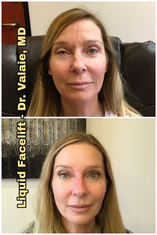 Liquid Face Lift Before & After - Dr. Valaie, MD
