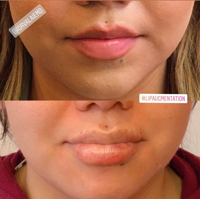 Lip Fillers by Dr. Valaie, MD - Cosmetic Surgeon Newport Beach, Orange County, CA