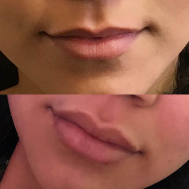 Lip Fillers by Dr. Valaie, MD - Cosmetic Sugeron Newport Beach, Orange County, Calilfornia