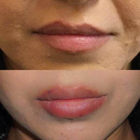 Lip Fillers by Dr. Valaie, MD - Cosmetic Sugeron Newport Beach, Orange County, Calilfornia