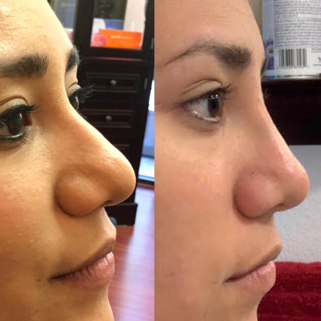 Liquid Nose Job by Dr. Valaie, MD - Cosmetic Sugeron Newport Beach, Orange County, Calilfornia
