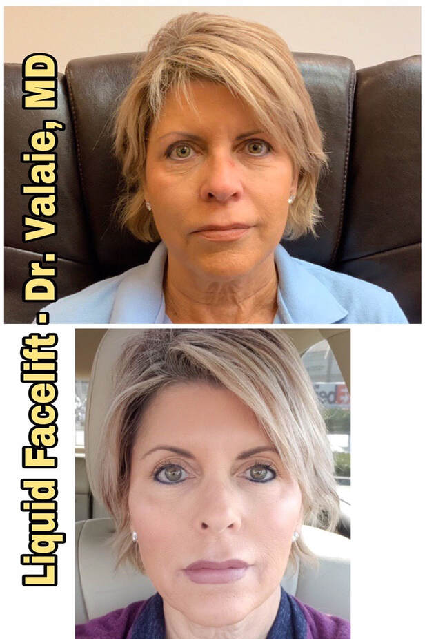 Liquid Facelift by Dr. Valaie, MD - Cosmetic Surgeon Newport Beach, Orange County, CA
