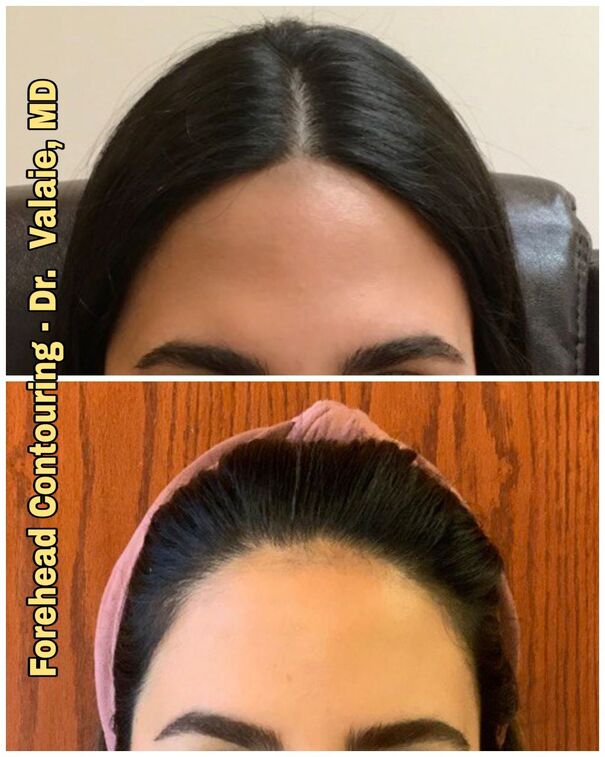 Forehead Contouring by Dr. Valaie, MD - Cosmetic Surgeon Newport Beach, Orange   County, CA