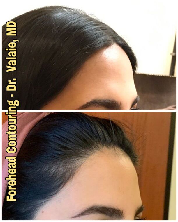 Forehead Contouring by Dr. Valaie, MD - Cosmetic Surgeon Newport Beach, Orange County, CA