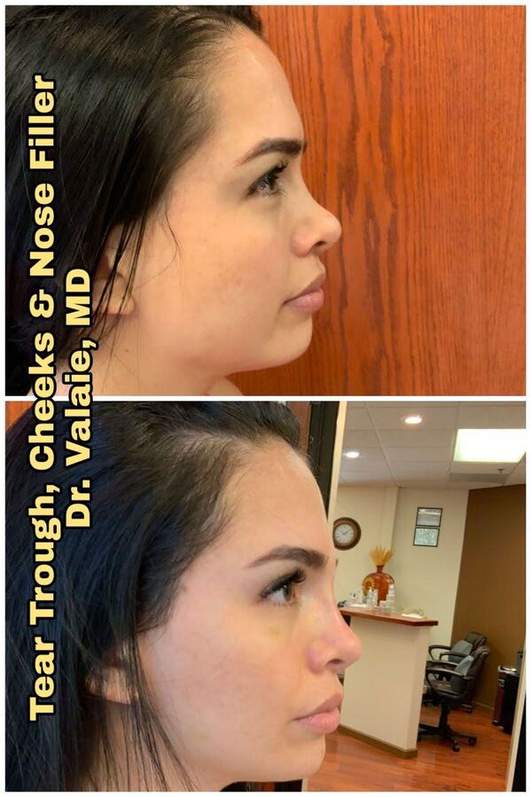 Tear Trough,Nose & Cheeks Fillers by Dr. Valaie, MD - Cosmetic Surgeon Newport Beach, Orange County, CA