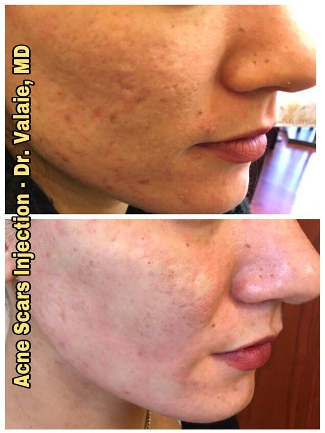 Acne Scar Injection by Dr. Valaie, MD - Cosmetic Surgeon Newport Beach, Orange County, CA