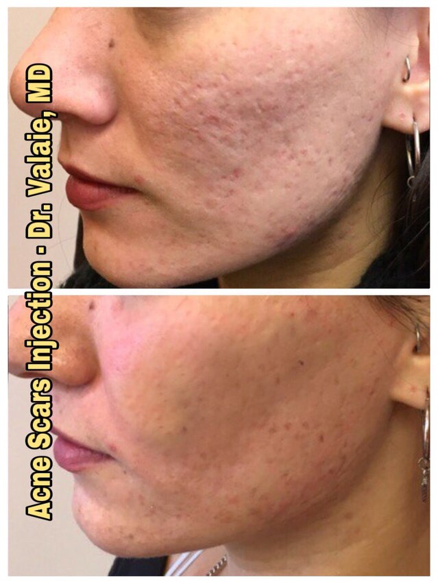 Acne Scar Injection by Dr. Valaie, MD - Cosmetic Surgeon Newport Beach, Orange County, CA