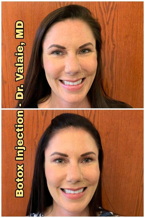 Botox Injection by Dr. Valaie, MD - Cosmetic Surgeon Newport Beach, Orange County, CA
