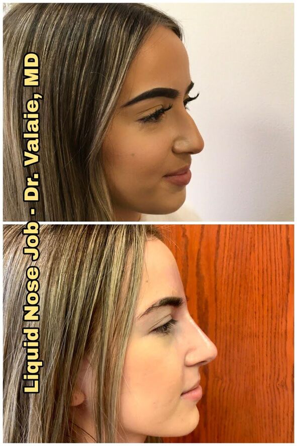 Liquid Nose Job by Dr. Valaie, MD - Cosmetic Surgeon Newport Beach, Orange County, CA