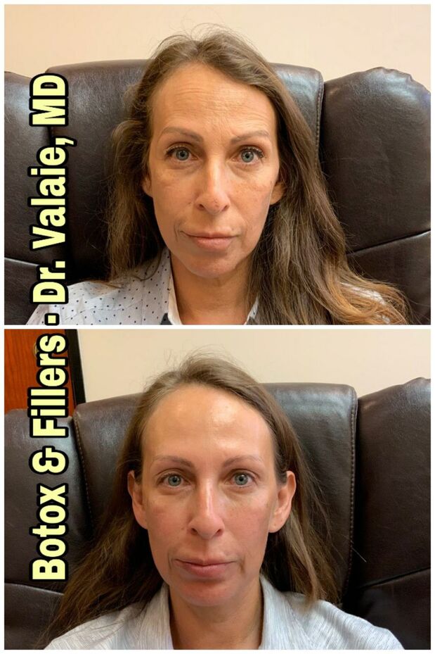 Botox & Fillers by Dr. Valaie, MD - Cosmetic Surgeon Newport Beach, Orange County, CA