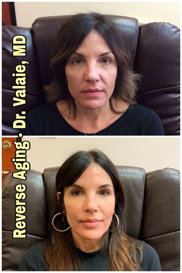 Reverse Aging by Dr. Valaie, MD - Cosmetic Surgeon Newport Beach, Orange County, CA