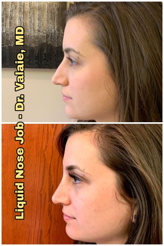 Liquid Nose Job by Dr. Valaie, MD - Cosmetic Surgeon Newport Beach, Orange County, CA