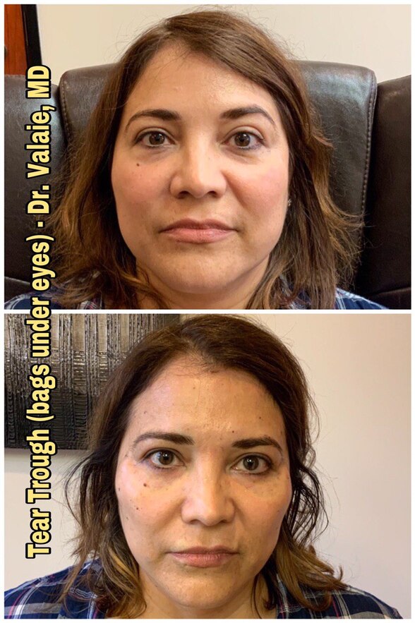 Tear Trough (bags under eyes)  by Dr. Valaie, MD - Cosmetic Surgeon Newport Beach, Orange County, CA