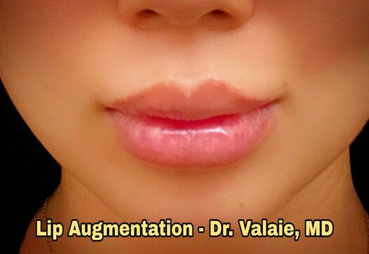 Lip Augmentation by Dr. Valaie, MD - Cosmetic Surgeon Newport Beach, Orange County, CA