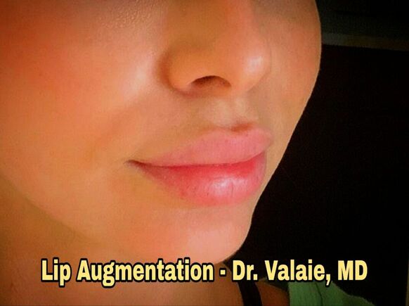 Lip Augmentation by Dr. Valaie, MD - Cosmetic Surgeon Newport Beach, Orange County, CA