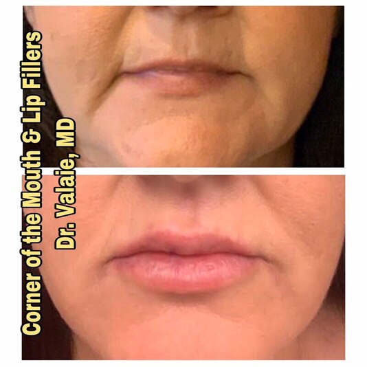 Corner of the Mouth & Lip Fillers by Dr. Valaie, MD - Cosmetic Surgeon Newport Beach, Orange County, CA