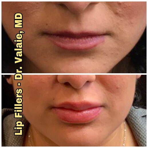 Lip Fillers by Dr. Valaie, MD - Cosmetic Surgeon Newport Beach, Orange County, CA