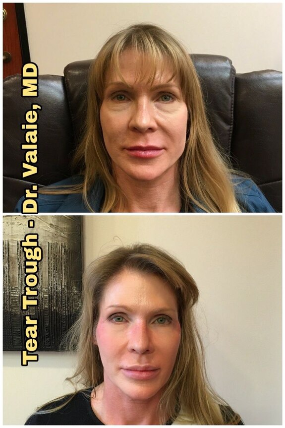 Tear Trough,Lip & Cheeks Fillers by Dr. Valaie, MD - Cosmetic Surgeon Newport Beach, Orange County, CA