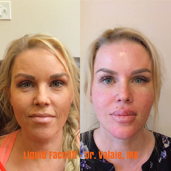 Liquid Nose Job  by Dr. Valaie, MD - Cosmetic Surgeon, Newport Beach, Orange County, CA