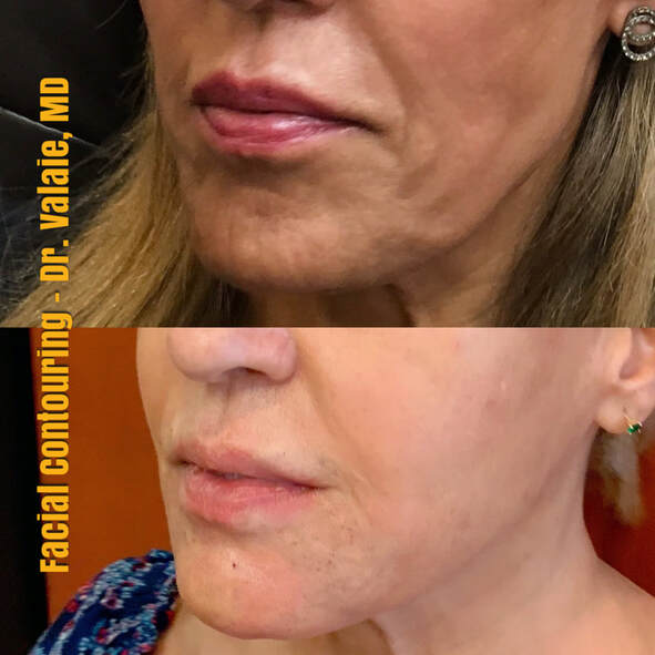 Facial Contouring by Dr. Valaie, MD - Cosmetic   Surgeon Newport Beach, Orange County, CA